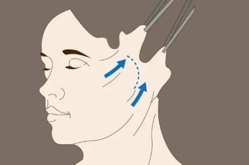 拉皮做大切口多久恢复？不同年龄段平均恢复时间参考